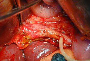 HEPATIC DUCT lateral BDI to