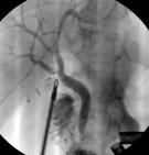 BDI due to to an ANOMALOUS R. R. HEPATIC DUCT STRATEGY OF TREATMENT do a selective cholangiography!