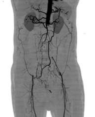 Fig 1 showing CIA, EIA and aortic bifurcation occlusion Fig 2: showing block in popliteal Arteries As compared to earlier studies there was similar sensitivity of CTA and DSA while lower specificity