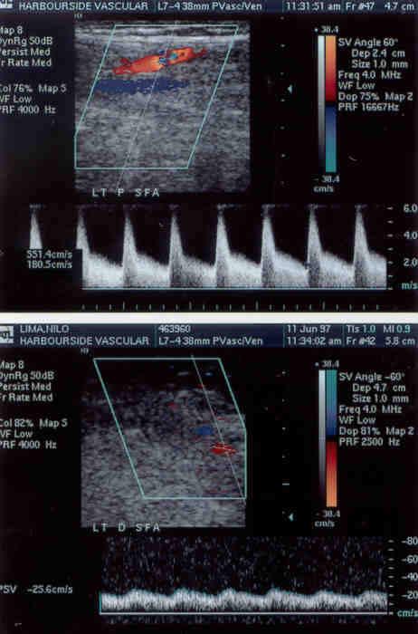 Arterial Stenosis >75% DR Stenosis in proximal SFA PSV=551 cm/s EDV=180 cm/s
