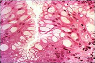 4) This biopsy was procured from a 68-year-old male patient with longstanding gastroesophageal reflux disease. Which of the following statements is true? A.