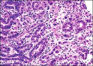 6) Which of the following statements is true regarding the image from a 72-year-old male with a long-standing history of Barrett s esophagus? A. This biopsy reveals an intraepithelial proliferation B.