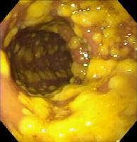 Endoscopic Diagnosis Not required but can be used to make diagnosis rapidly Finding of pseudomembranes essentially pathognomonic Findings may be atypical in IBD patients Learning Goals Understand the