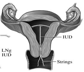 Intrauterine Contraception Intrauterine Devices Copper IUD Paragard Use up to 10 years Heavier periods No hormonal side effects Levonorgestrel releasing IUDs Mirena, Skyla and Liletta Local progestin