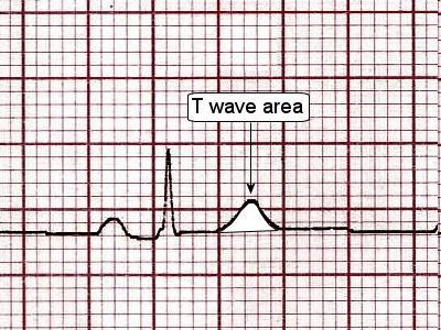 T wave: ventricular repolarization - amplitude: ~ 1/3 R, but it is considered normal within the ¼ R
