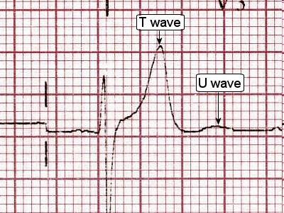 Wave U Amplitude usually < 1/3 T wave amplitude in same lead direction - the same as T wave direction in the same lead more prominent at slow HR, best seen in the right