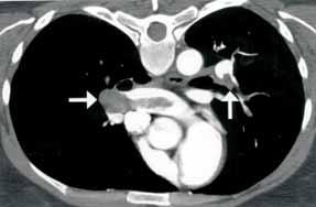 Jornal Brasileiro de Pneumologia 30(5) - Set/Out de 2004 Figure 3- Acute pulmonary thromboembolism in 37-year old man.