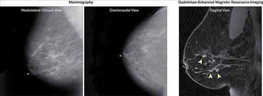 Surveillance of BRCA1 and BRCA2 Mutation Carriers With Magnetic Resonance Imaging, Ultrasound, Mammography, and Clinical Breast Examination N= 236 Canadian women aged 25 to 65 years with BRCA1 or