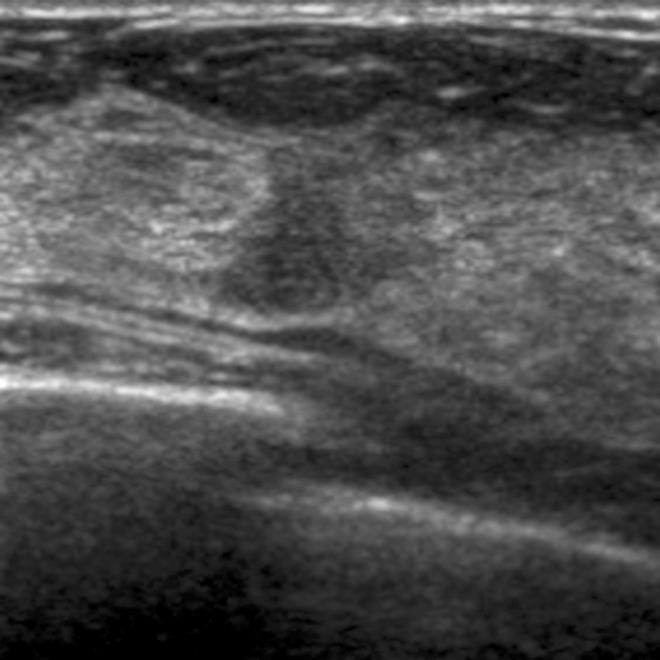 Breast Ultrasound Detects small invasive cancers not seen on mammography Reduced specificity Handheld ultrasound is user-dependent and very labor intensive May be beneficial