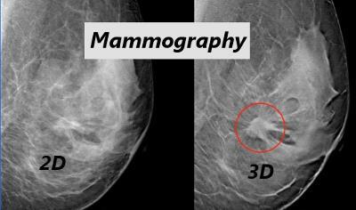 Improving sensitivity and specificity Digital breast tomosynthesis Ultrasound Breast Screening Research Contrast imaging based on angiogenesis MRI
