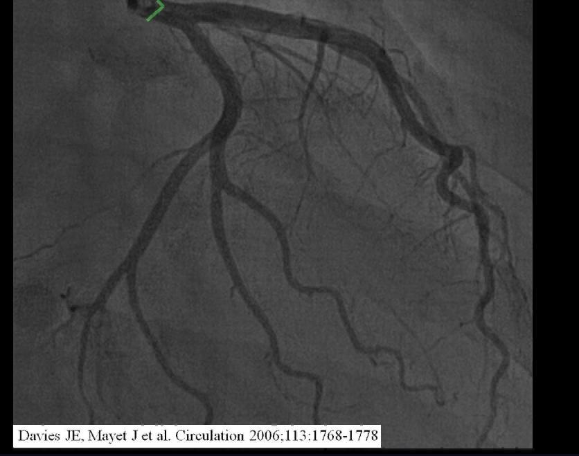 What is the mechanism of coronary arterial flow?