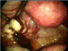typical for endometriosis with formation of an
