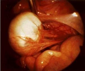 The hemorrhage from endometriosis into the ovary may