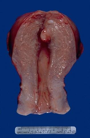 Seen here are submucosal,