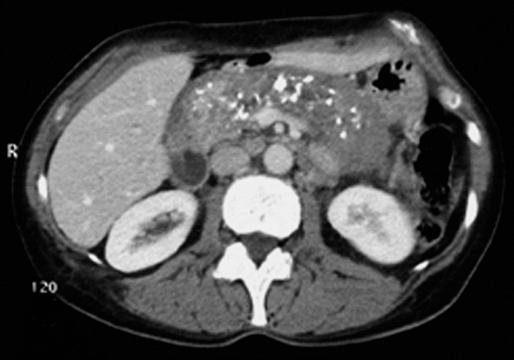 side branches of the Two of the following pathological findings: main pancreatic duct Cysts Duct irregularities Focal acute pancreatitis Heterogeneity of the parenchyma Increased echogenity of the