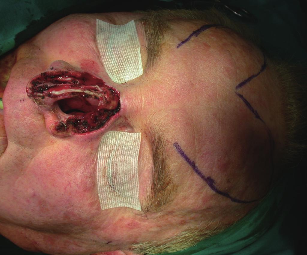 Agostini T et al. Bi-pedicled forehead flap for nasal reconstruction Fig. 2. Preoperative image of an 83-year-old man A T4N0M0 squamous cell carcinoma i nvolving the nasal ala and dorsum.