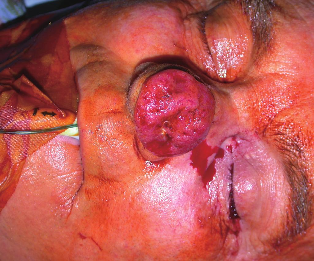This flap is equipped with a rich vascular network thanks to the intersection of the supratrochlear and supraorbital arteries on the one hand and to the angular veins on the other.