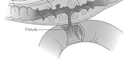 Ulcerative Colitis Complications Perforated colon Toxic megacolon High risk for colon cancer Crohn s Disease Pathophysiology
