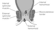 Hemorrhoids Manifestations Pain, rupture, bleeding Hemorrhoids