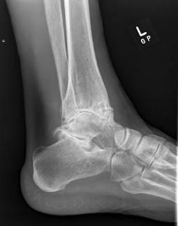 Joint Debridement Usually to remove osteophytes or graft