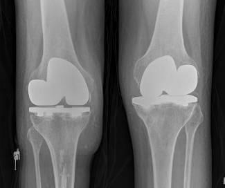 Knee replacement Extra components Longer surgery Difficult rehab Length of stay longer - factor Post op ROM increased 60 deg Patient