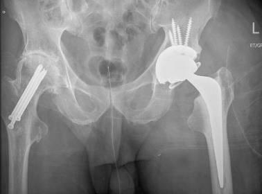 Hip replacement Uncommonly affected in Haemophilia But can get hip