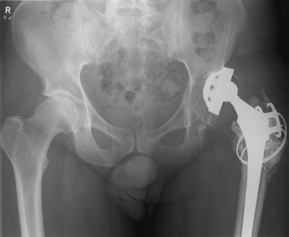 Hip replacement Sometimes side effects of