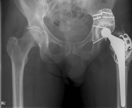 Hip replacement Revision surgery needs a range of solutions First