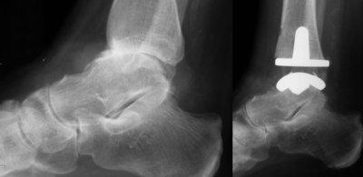 Ankle replacement Results in osteoarthritis acceptable But in