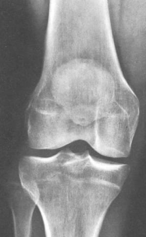 Normal Knee X- ray