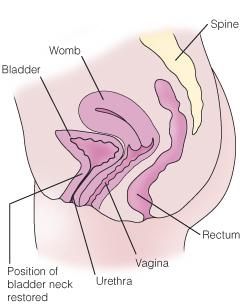 You can have surgery to lift your bladder back to its correct position.