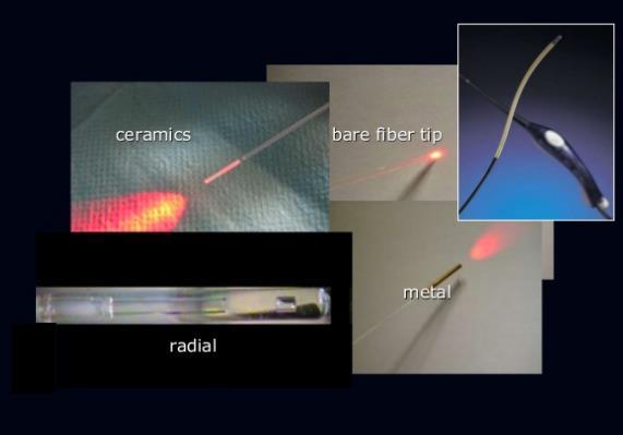 ELA Different laser fiber can be used. Bare-tip fibers, jacket-tip fibers, radial fibers.