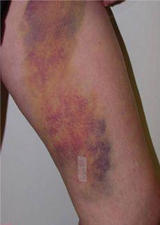 ELA/RFA COMPLICATIONS Ecchymosis over the treated segment frequently occurs and normally lasts for 7-14 days.