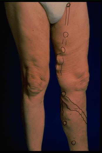 CHRONIC VENOUS INSUFFICIENCY CVI is a significant public health problem in the United States.