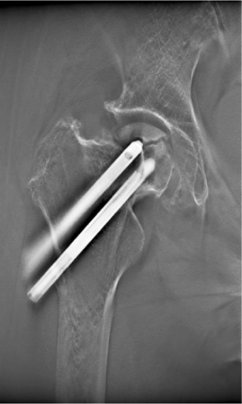 Case 2 86-year-old female Main complaint: Right femoral pain