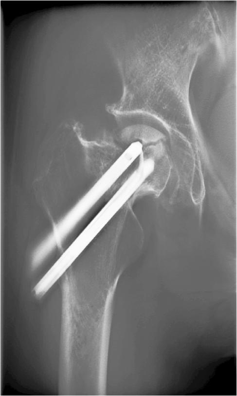 A spinous process fracture was indicated (Fig. 10).