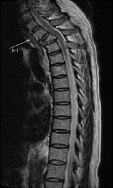Past history: Surgery for spinal stenosis scan of head and plain radiography,, and scans of