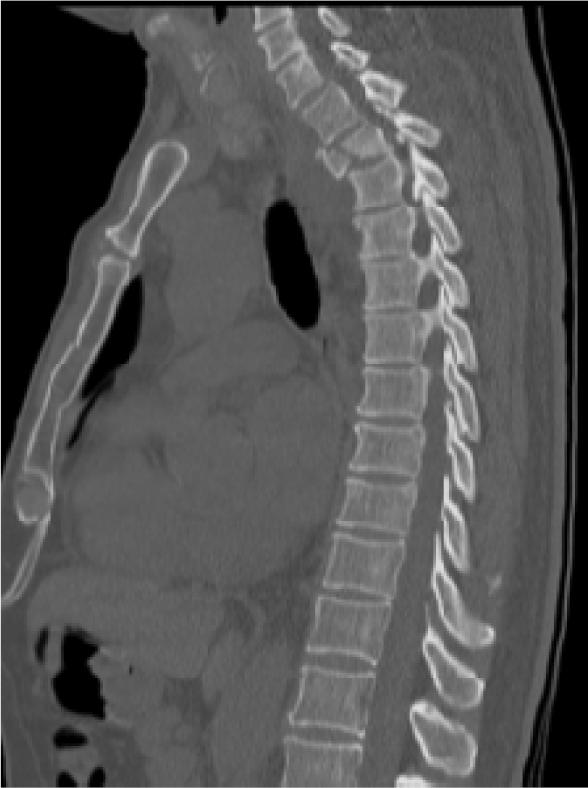 surface of 1st thoracic vertebra. Epidural hematoma (Fig. 12) was also present.