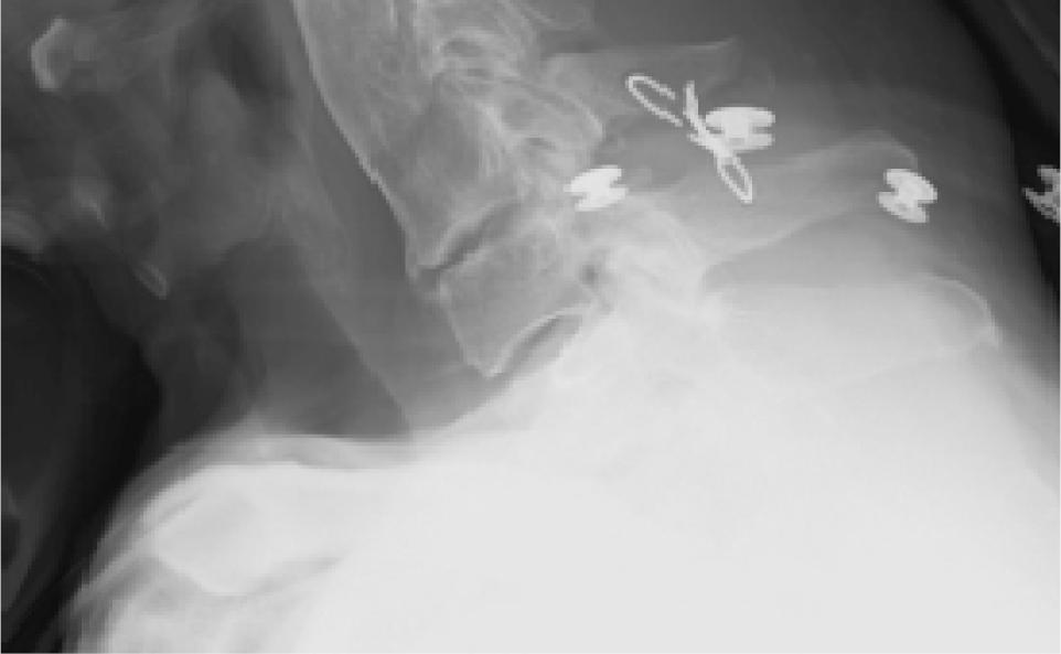 Burst fracture of 2nd thoracic vertebra, fractured sternum, and lung contusion Treatment