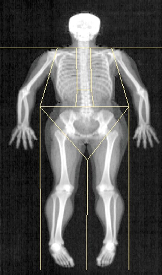 DXA ESTIMATION DXA determines all body composition and in defined regions, such as the arms, legs, and trunk.
