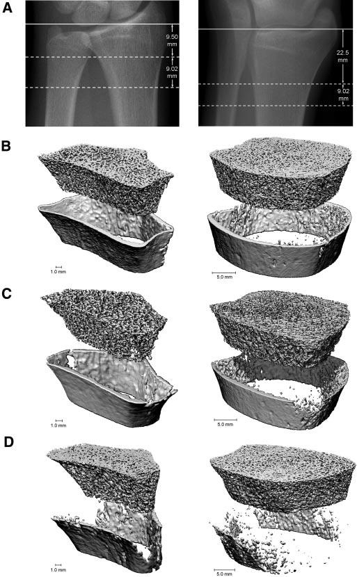 CLINICAL RESEARCH Figure 2. HR-pQCT provides detailed images of bone geometry and microarchitecture at the radius (left) and tibia (right).