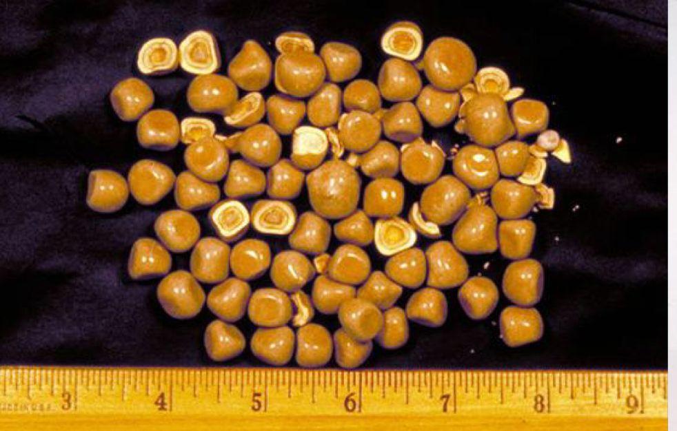 Calcium Salt Stones 80% of kidney stones contain calcium (mostly ca-oxalates, ca-po4)