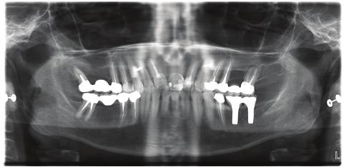7: x-ray follow-up after 10 months Conclusion: The new two-piece ceramic implant from Z-Systems shows