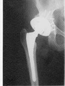 failure despite his trauma. The fourth complication was an acetabulor dislocation in a patient with a failed traumatic acetabular fracture ORIF (Figure 3a).