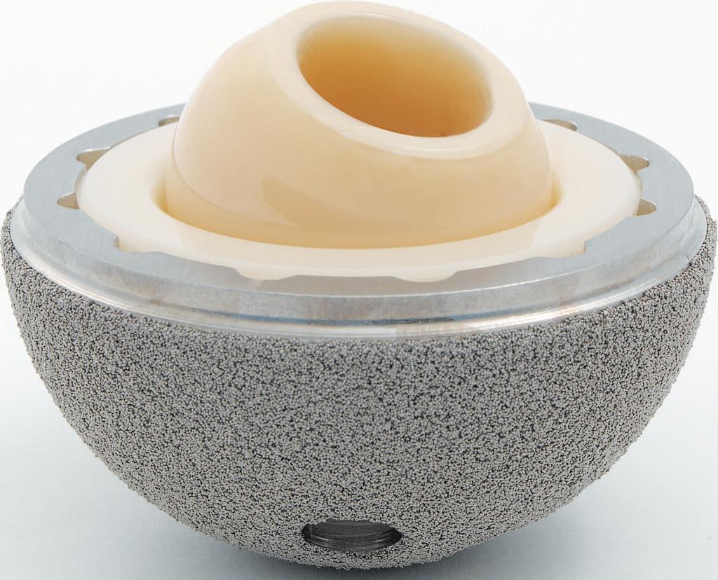 Alumina Ceramic Femoral Head on Ceramic Liner * Reduced wear Newer alumina ceramics have been available for three years and combine high material hardness with smooth surface finishes to minimize