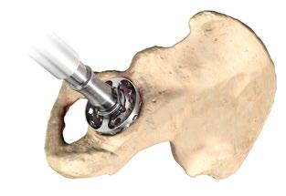 Subsequent reaming should proceed in 1-2 mm increments. Center the graters in the acetabulum until the deepened socket becomes a true hemisphere. Use a curette to free all cysts of fibrous tissue.