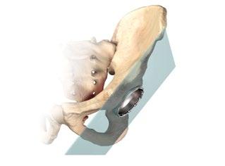 In a normal acetabulum with good lateral coverage, if the implanted socket lies flush with a normal lateral pillar, the abduction