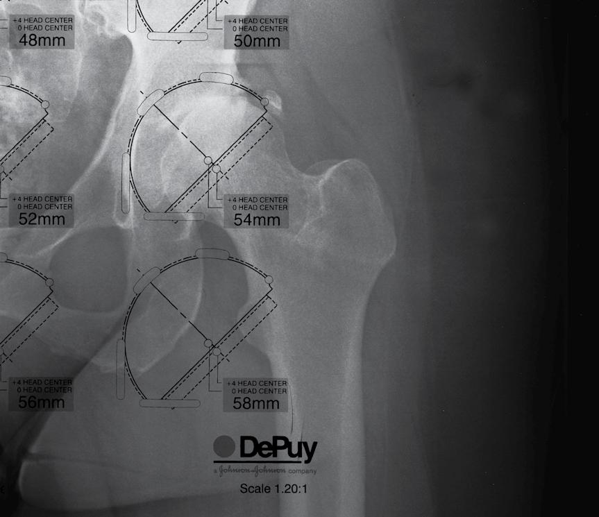 The pre-operative A/P x-ray can be helpful in determining how much of the acetabular component should be left uncovered to provide