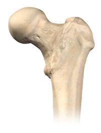 The notch on the medial aspect of the template indicates the most distal point for making the neck resection.