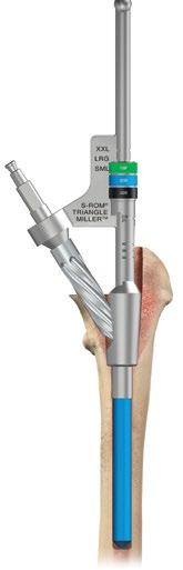 Step 4 Cone Reaming Step 5 Calcar Triangle Milling Step 6 Trial Implantation Step 7 Final Implantation Upon completion of distal reaming, prepare the proximal or cone portion of the final sleeve to